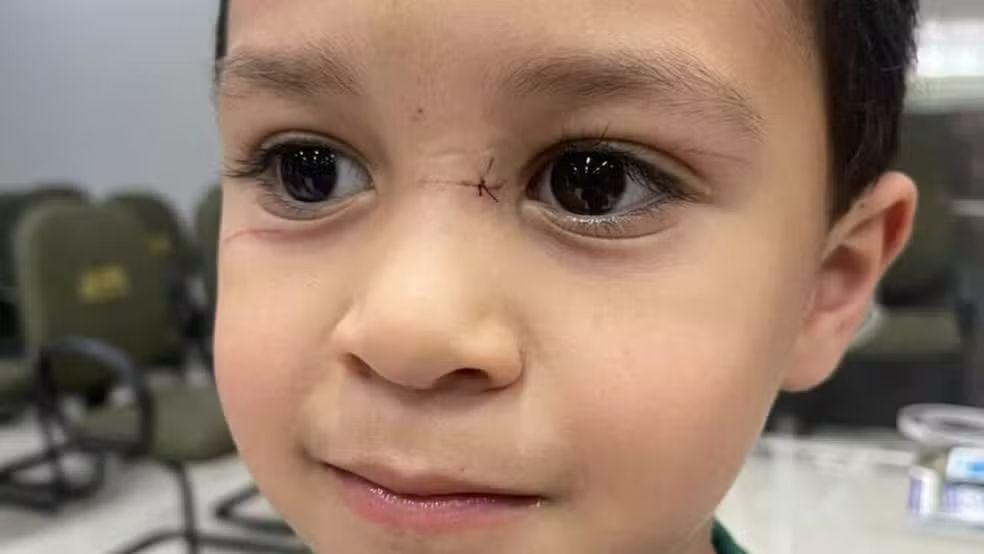 'Poderia perder a visão', diz mãe do menino de 4 anos que teve o rosto cortado por linha com cerol em BC
